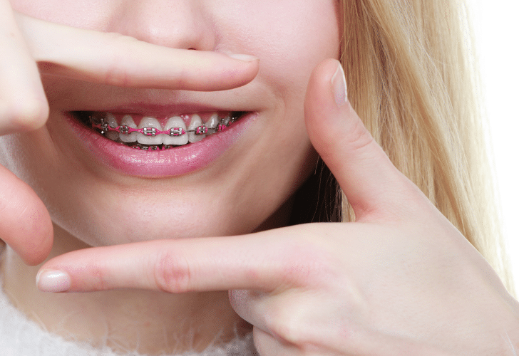 girl wearing braces